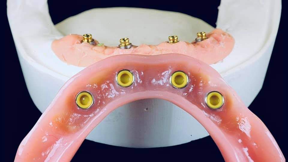 Dental Bridge