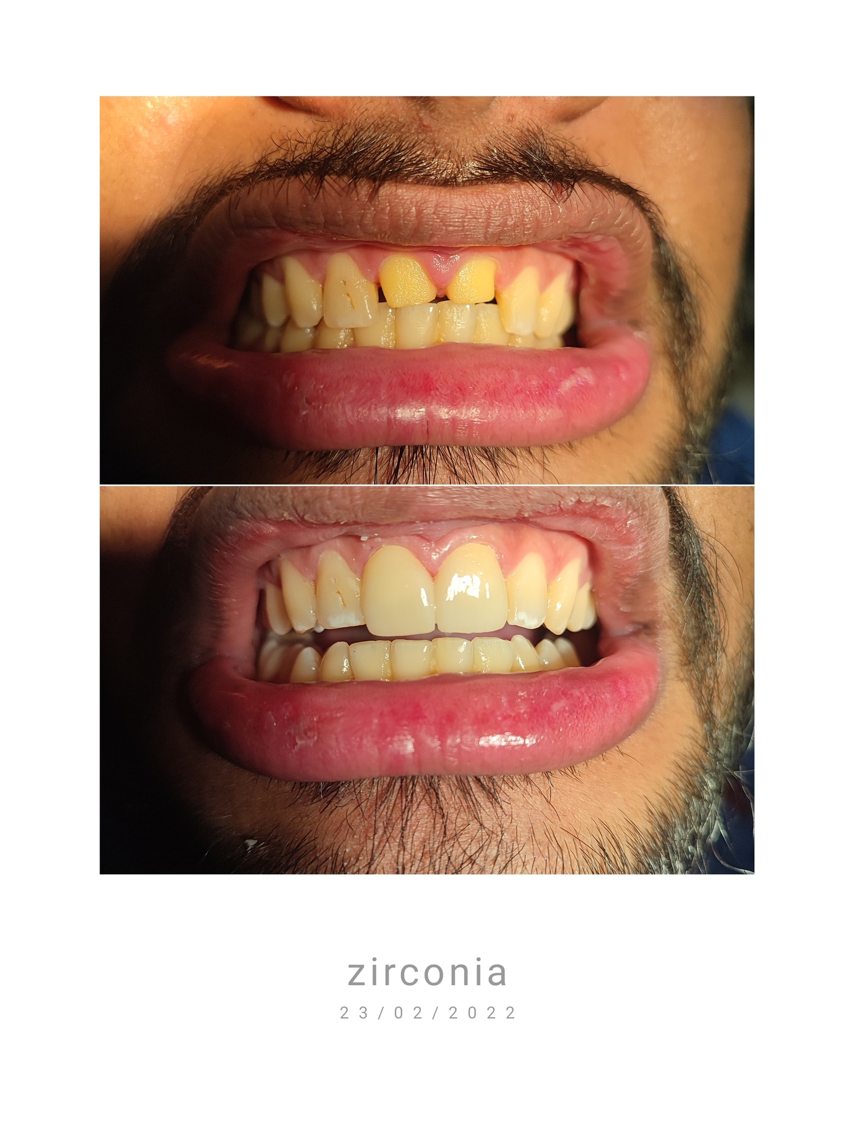 Root Canal Treatment