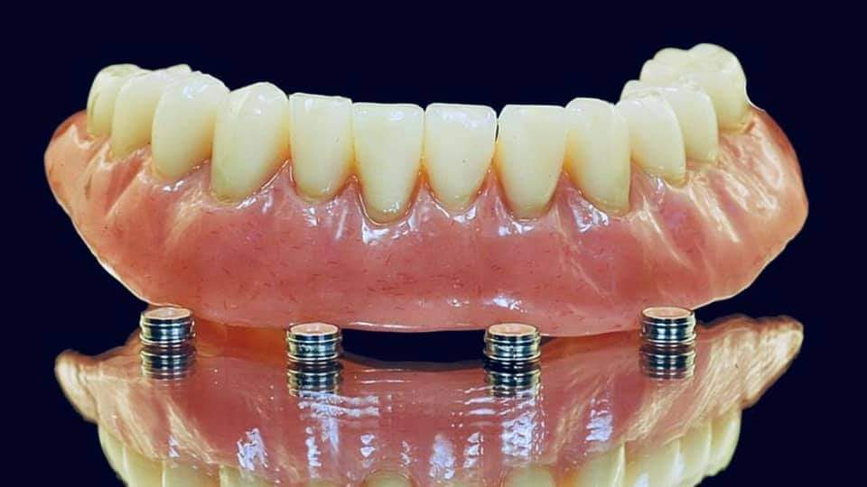 Dental implants