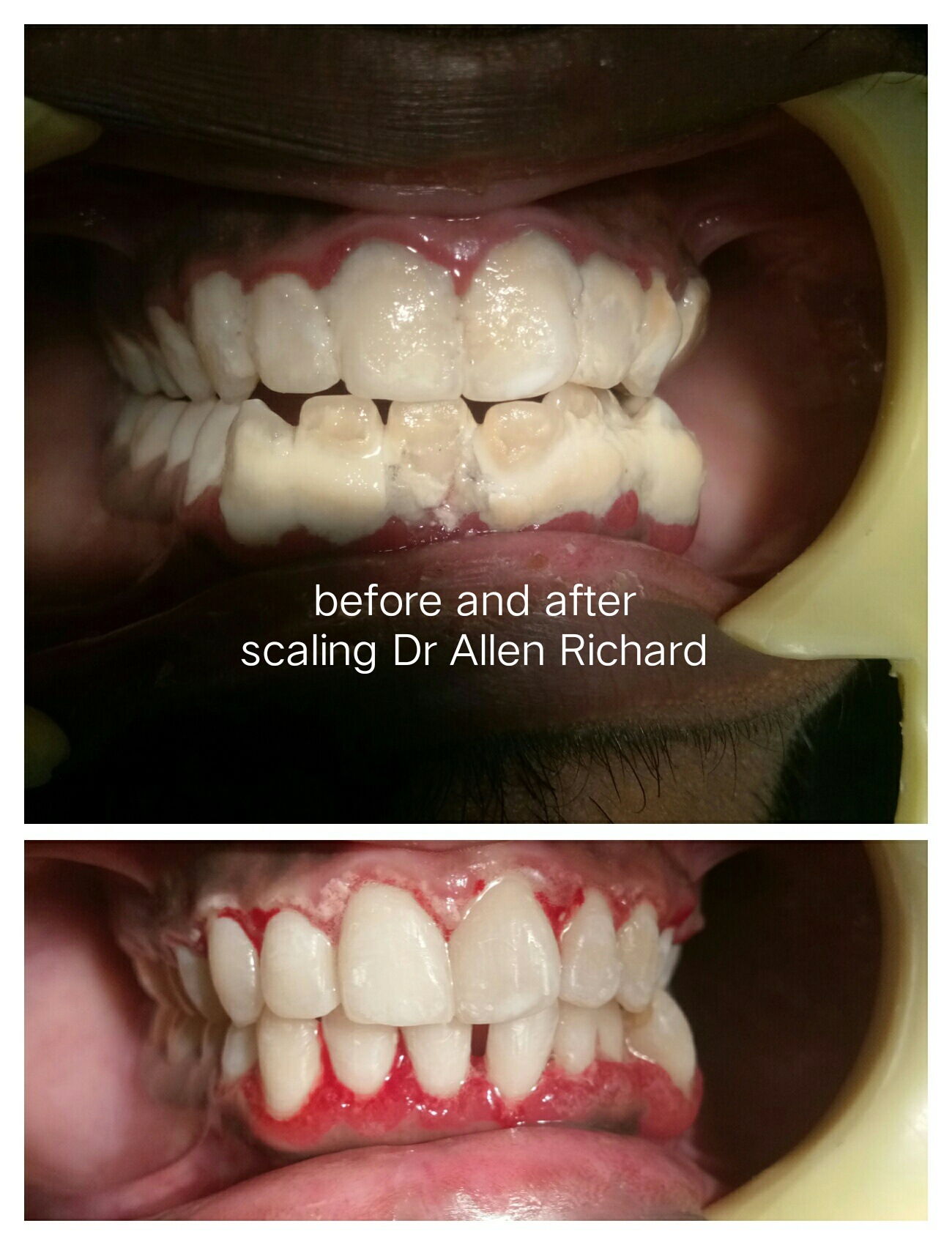 Root canal treatment